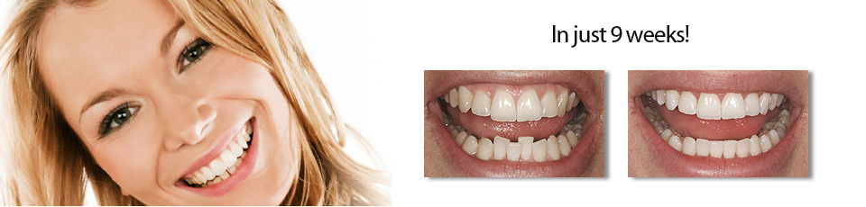 Inman Aligner
