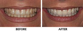 Align and Veneers