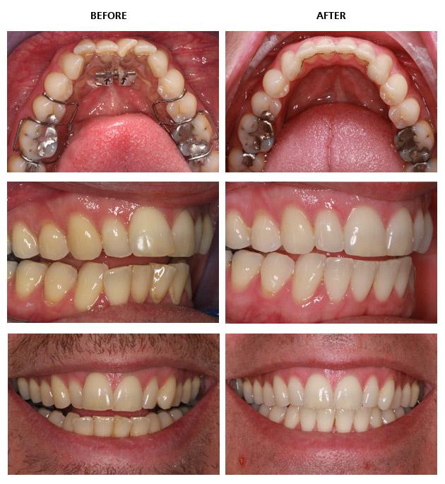 Inman Aligner Before And After Pictures - Inman Aligner